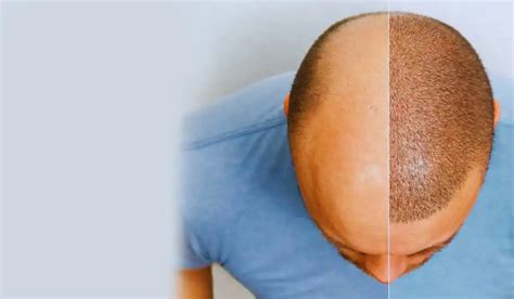 scalp micropigmentation albuquerque|Scalp Micropigmentation .